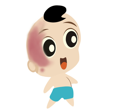 红胎记治疗起来麻烦吗？